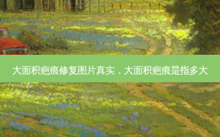 大面积疤痕修复图片真实，大面积疤痕是指多大